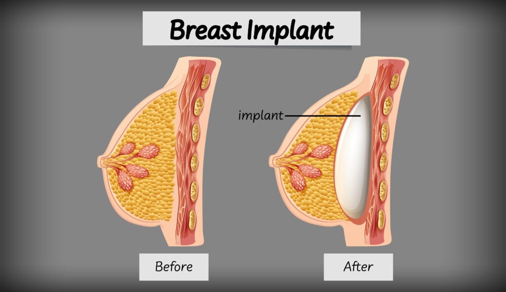 Breast Implants