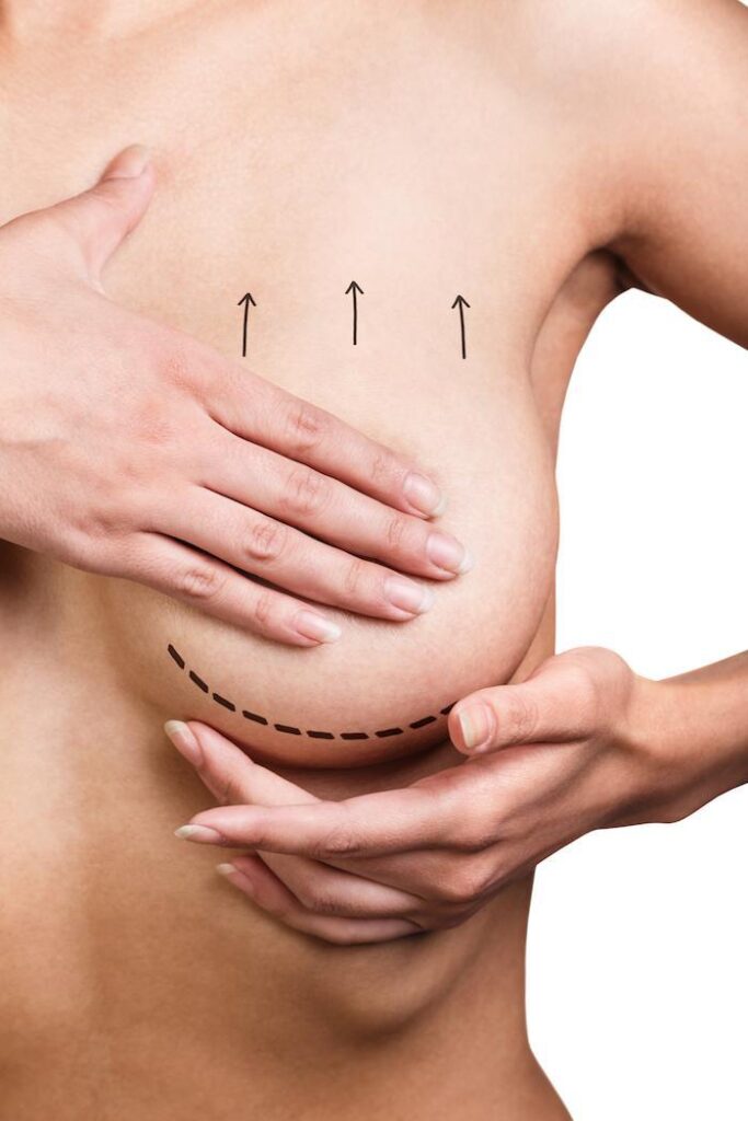 Vertical or Lollipop Breast Lift