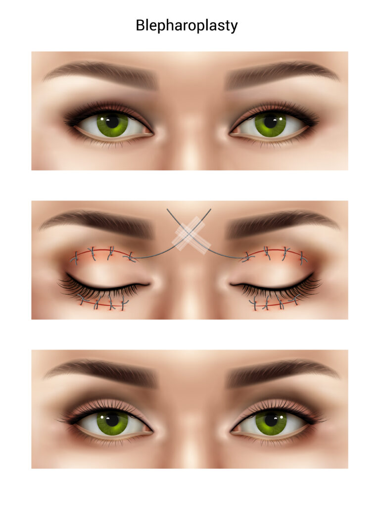 Combined Upper and Lower Blepharoplasty (Copy)