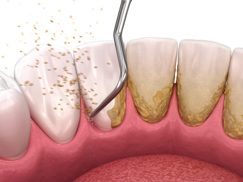 Full Mouth Scaling and Root Planing