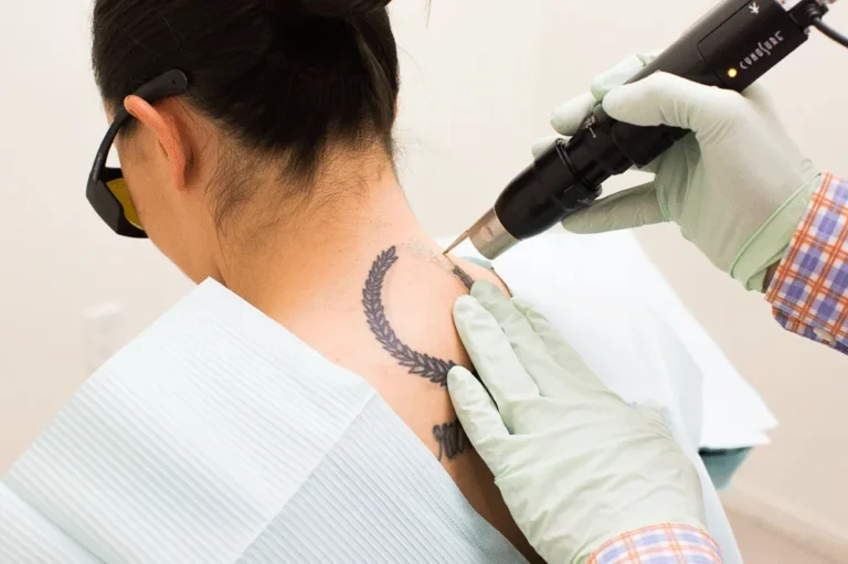 Laser Tattoo removal