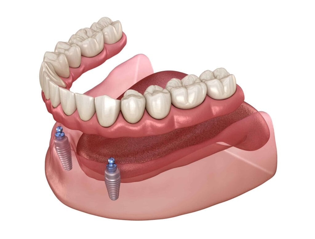 Implant-Supported Dentures