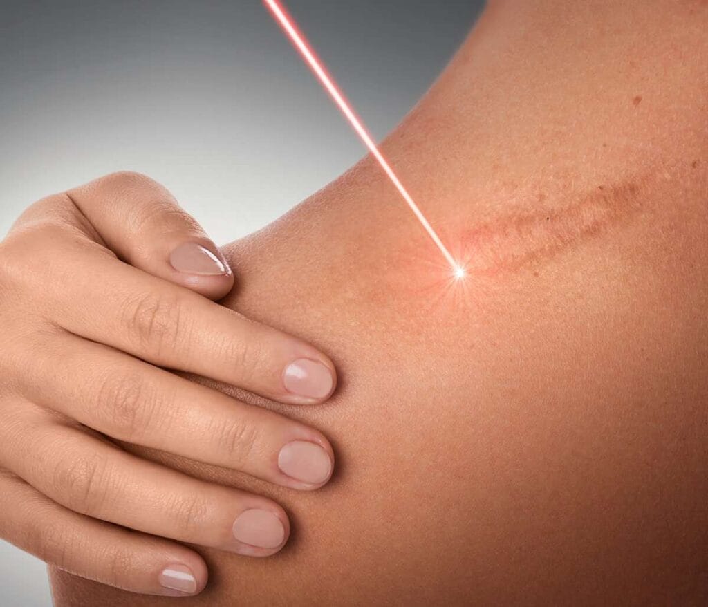 Laser scar revision