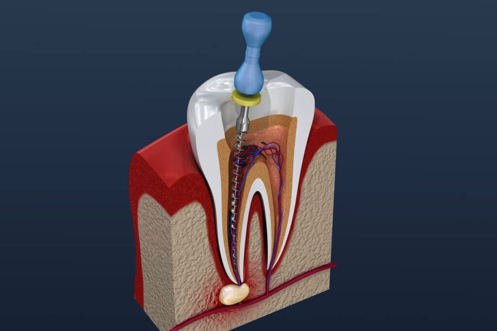 Stanadrd Root Canal Treatment
