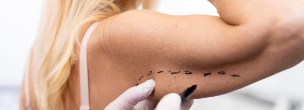 Arm Lift Surgery (Brachioplasty)