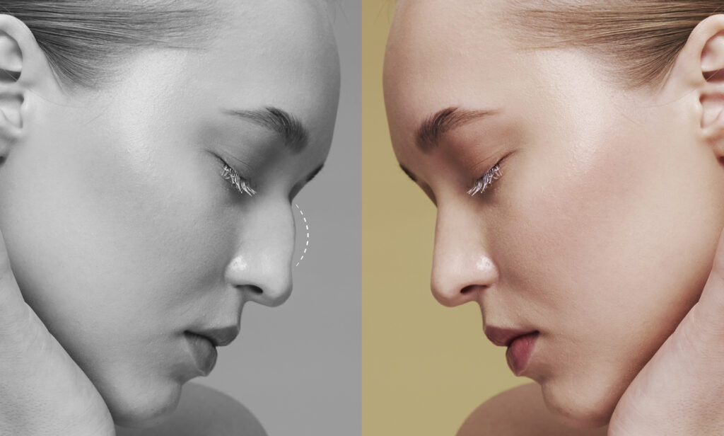 Closed Rhinoplasty