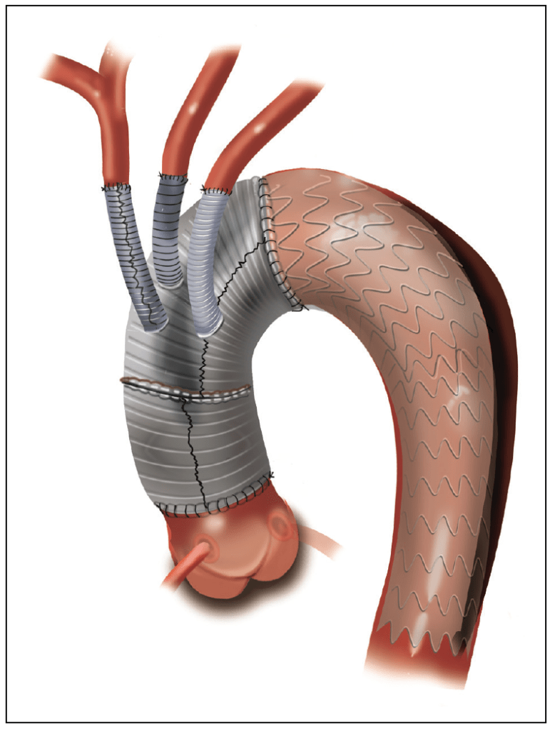 Aortic Arch Surgery