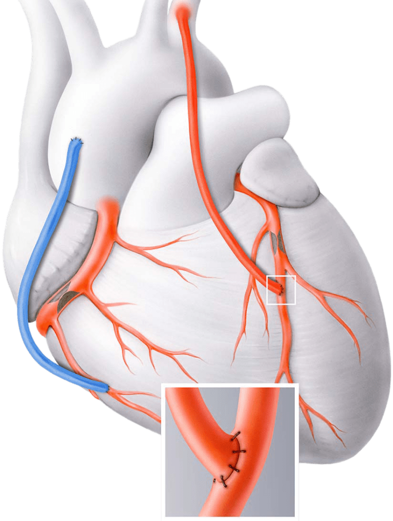 CABG (Coronary Artery Bypass Grafting)