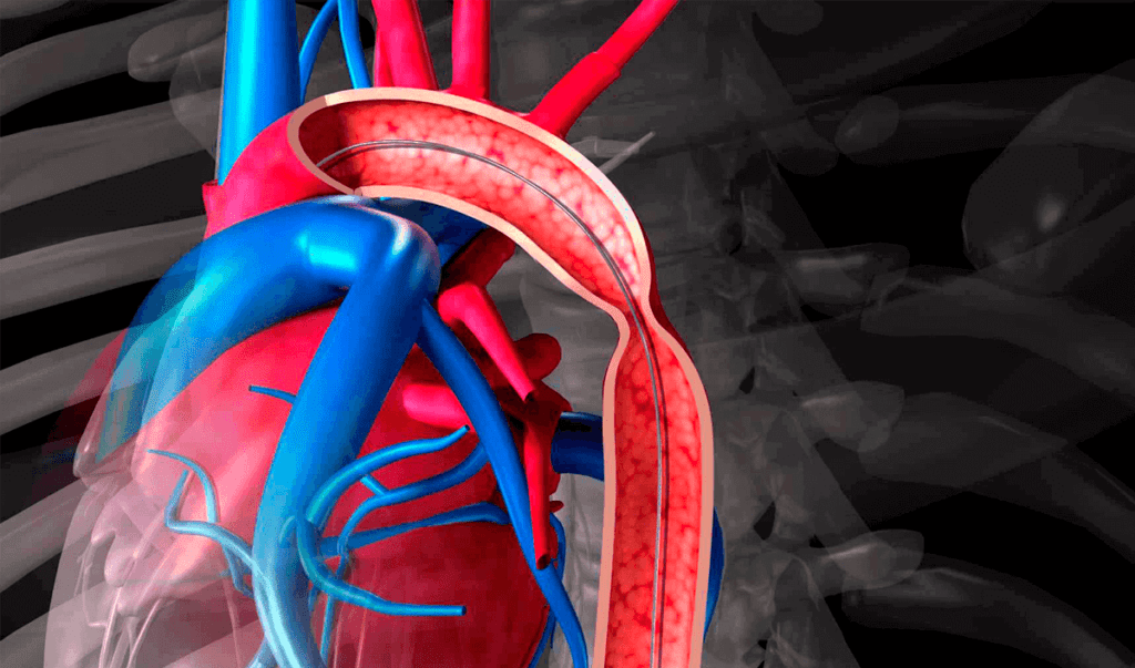 Coarctation of the Aorta Repair