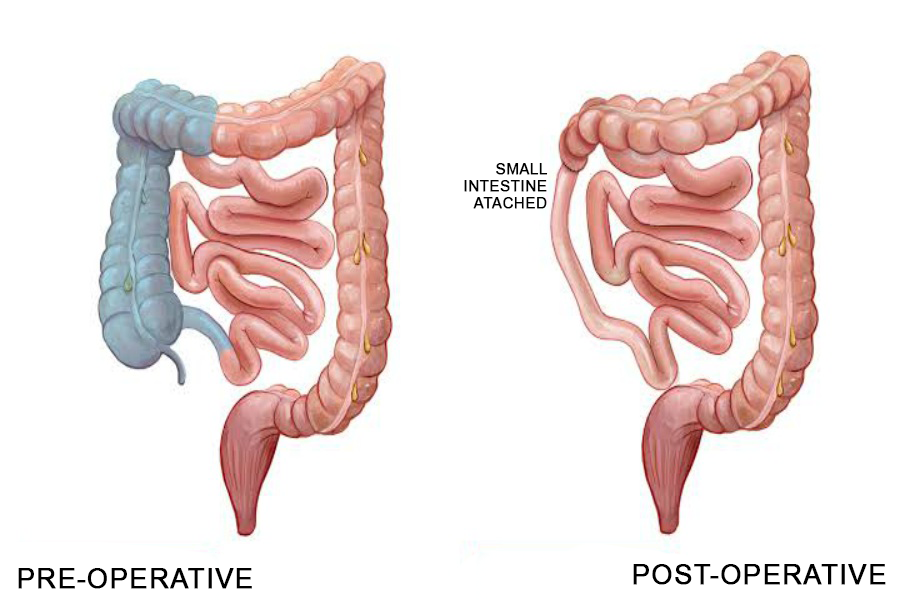 Partial Colectomy