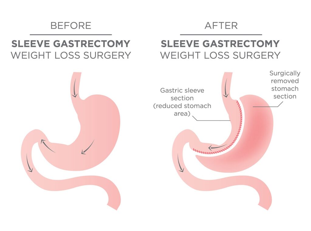 Sleeve Gastrectomy - Gastric Sleeve Surgery