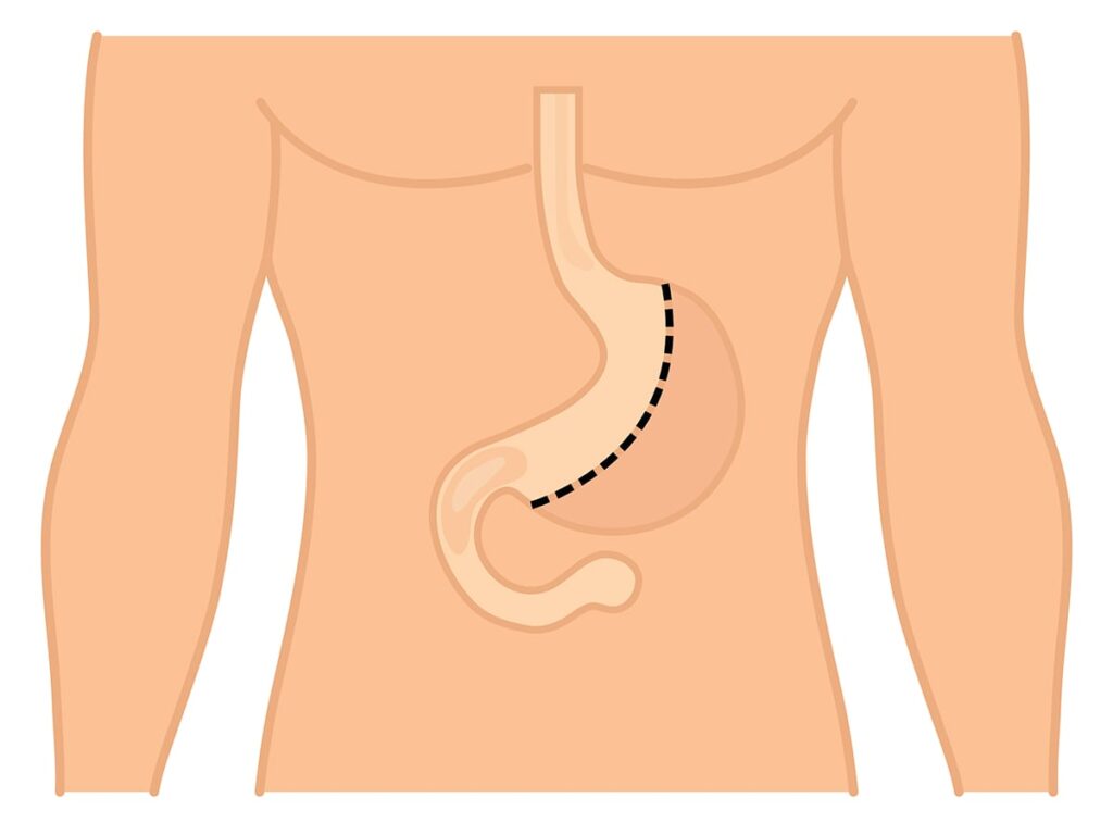 Partial Gastrectomy