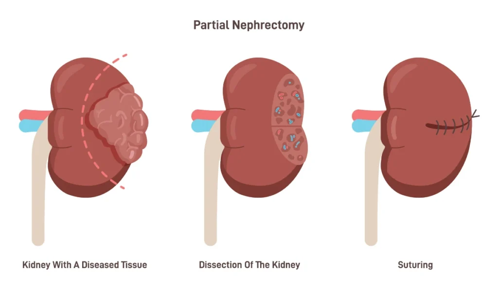 Nephrectomy