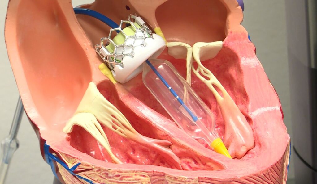 TAVI (Transcatheter Aortic Valve Implantation)
