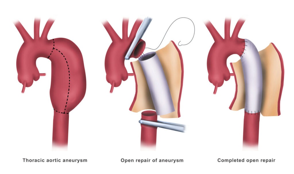 Aortic Aneurysm Repair
