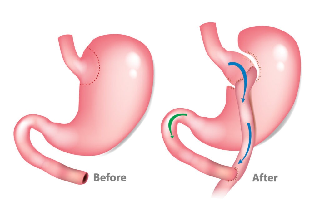 Gastric Bypass Surgery (Roux-en-Y Gastric Bypass)