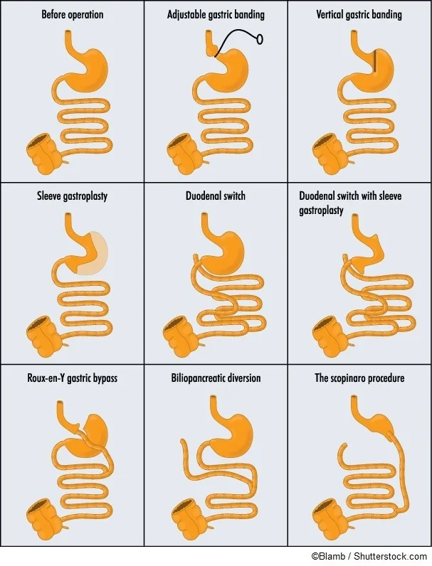 Types_of_gastric_bypass_operations_-_Blamb_