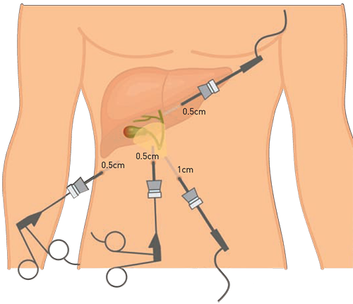 Laparoscopic Cholecystectomy