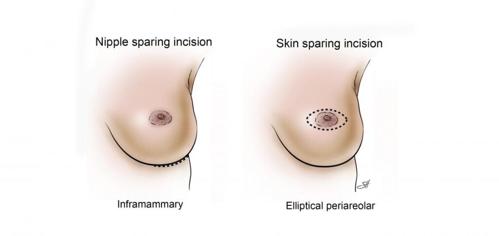 Skin-Sparing Mastectomy