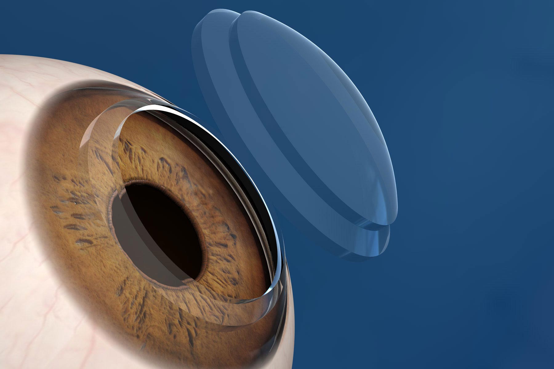 Insertion of Corneal Ring Using Femtosecond Device (One Eye) - Ring is Excluded