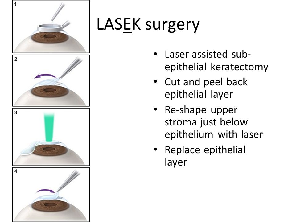 SMILE or Small Incision Lenticule Extraction with Femtosecond Laser (Both Eyes)