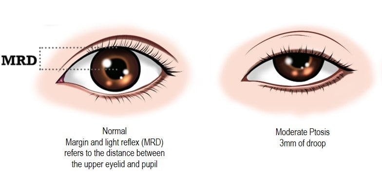 Ptosis Surgery (One Eye)