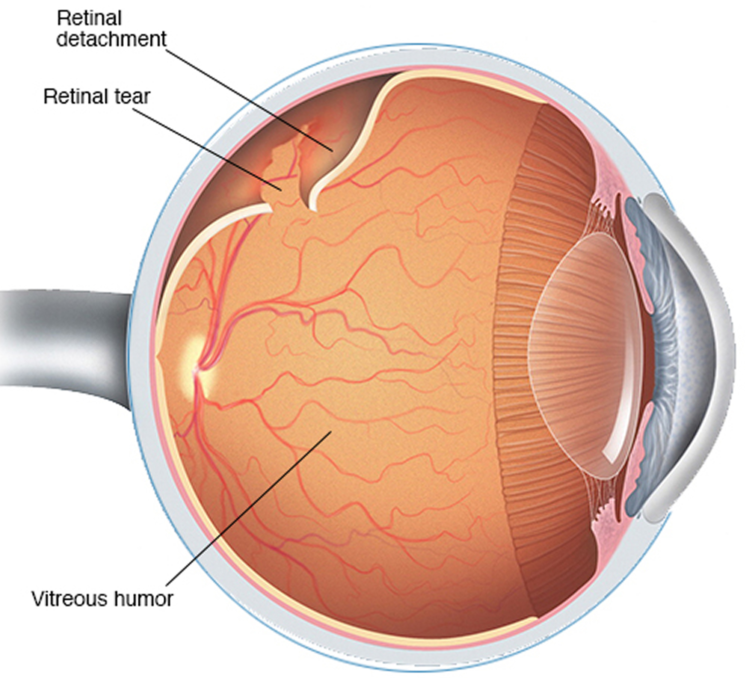 Scleral Buckling Surgery for Retinal Detachment (One Eye)