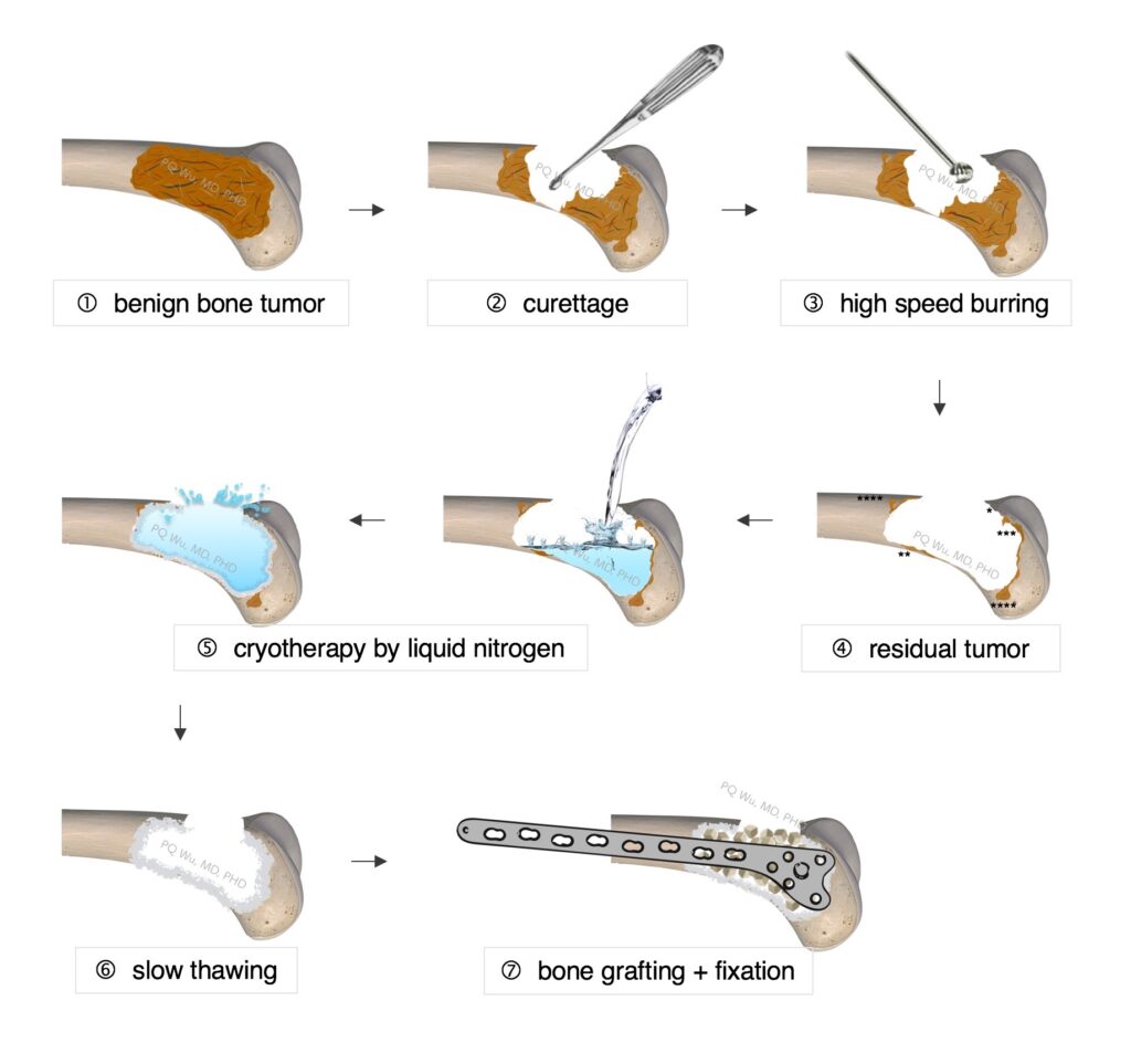 Bone Tumor Resection