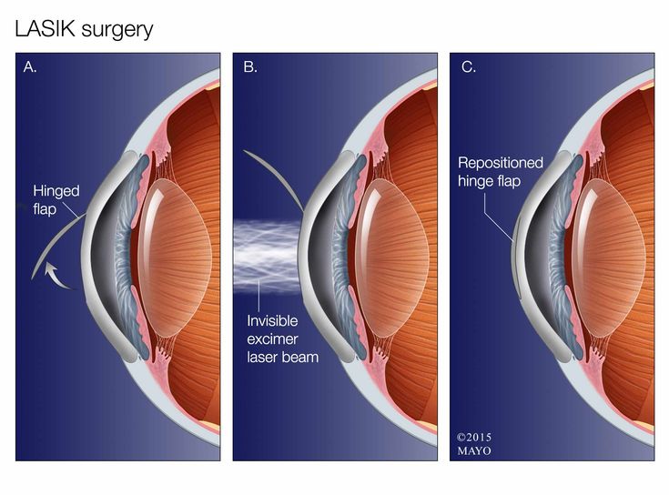 Persbyopia Correction Using Femtosecond Device (Both Eyes)