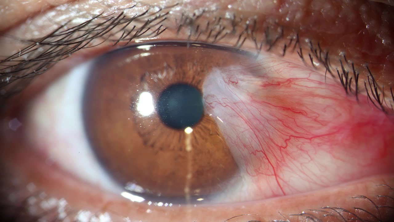 Pterygium Surgery with Graft (One Eye) - Tissue is Included