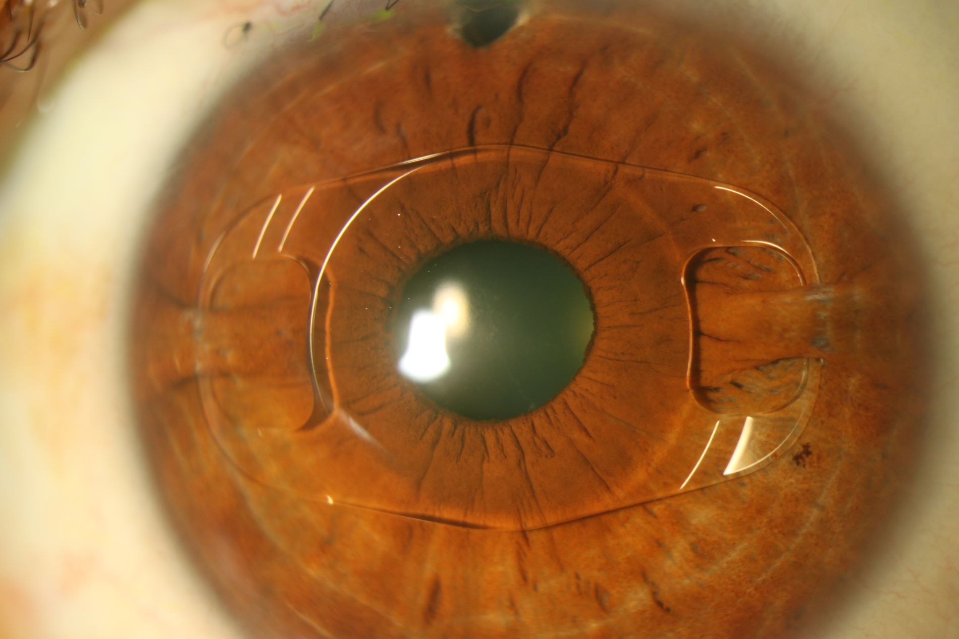 Artisan & Artiflex Implantation (One Eye) - Lens are excluded