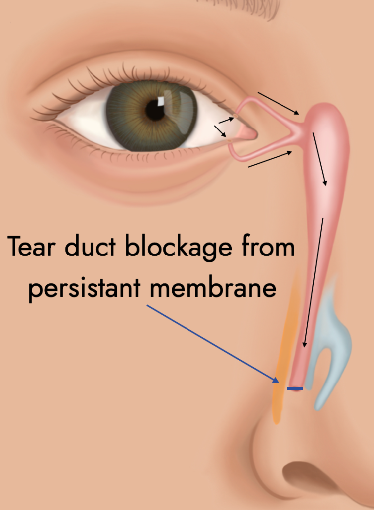 Duct Probing (Both Eyes)