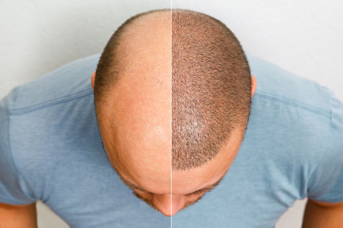 Hair Transplants - Follicular Unit Transplantation (FUT)