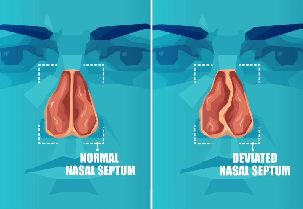 Traditional Septoplasty