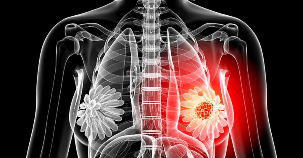 Breast Lesion Excision /excisional biopsy or lumpectomy