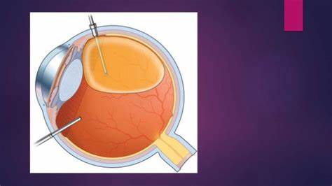 Silicon Oil Removal (One Eye)