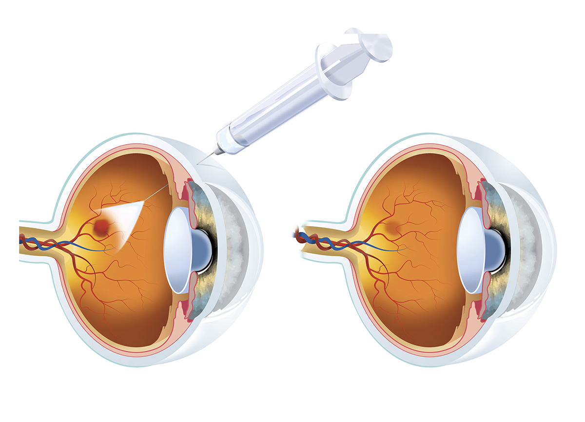 Eylea Intravitreal Injection (One Eye) - Eylea is Excluded