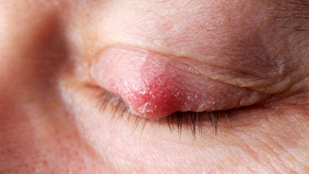 Chalazion (One Eye)
