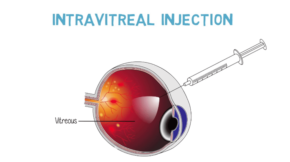 Avastin Intravitreal Injection (Both Eyes) - Avastin is Included