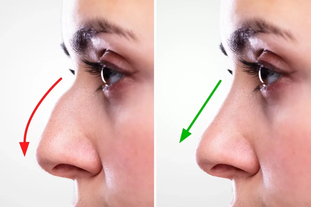 Closed Rhinoplasty