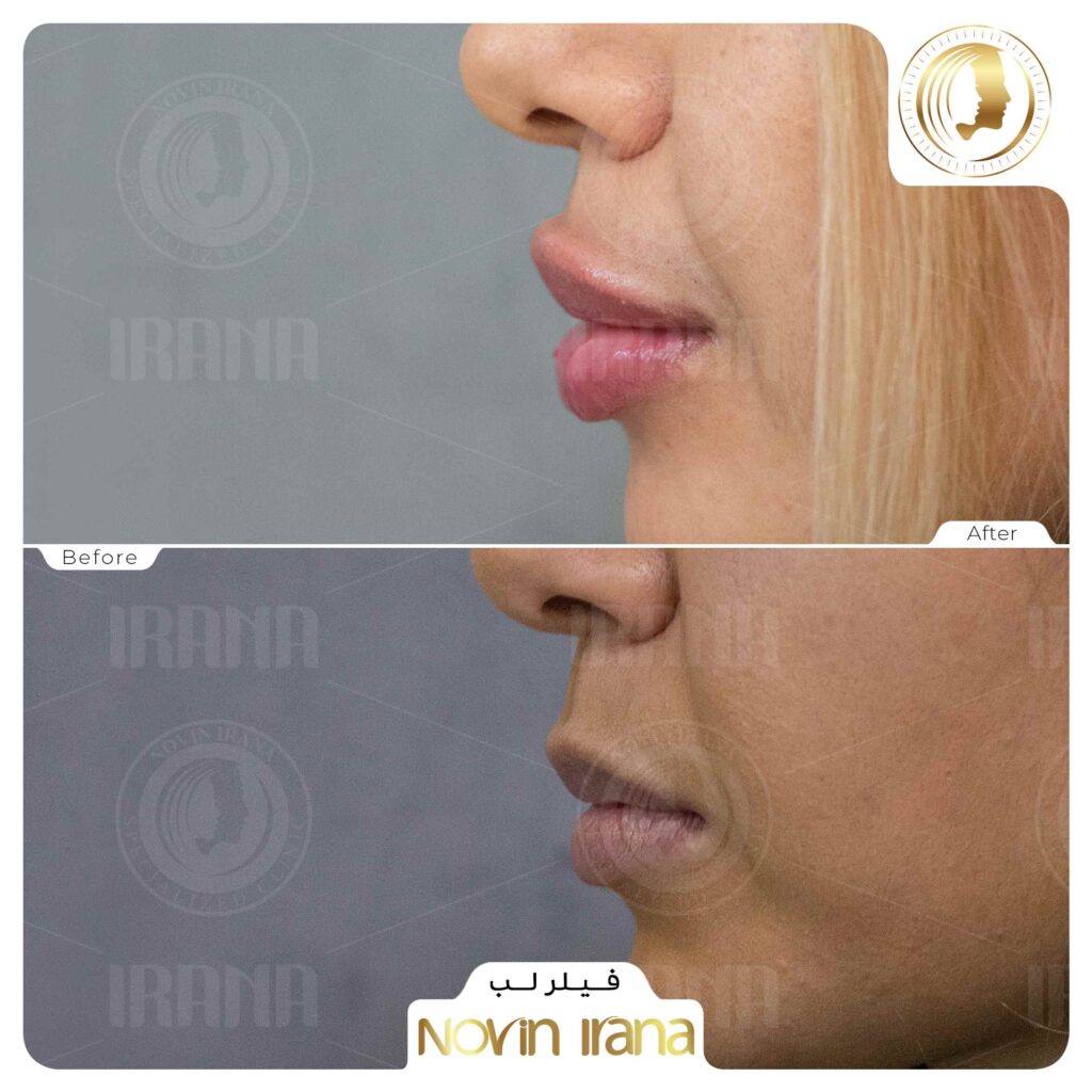 Filler injection - Gel injection