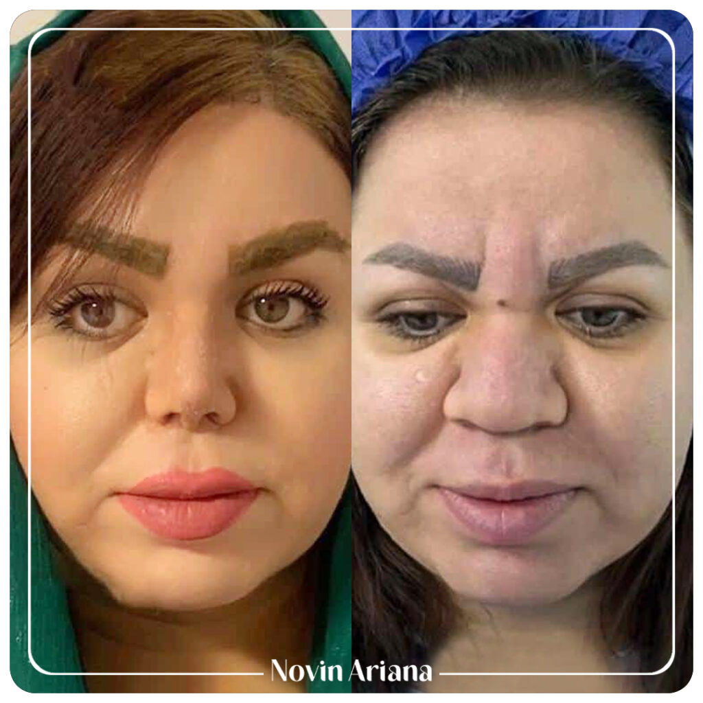 Rhinoplasty / Closed Rhinoplasty