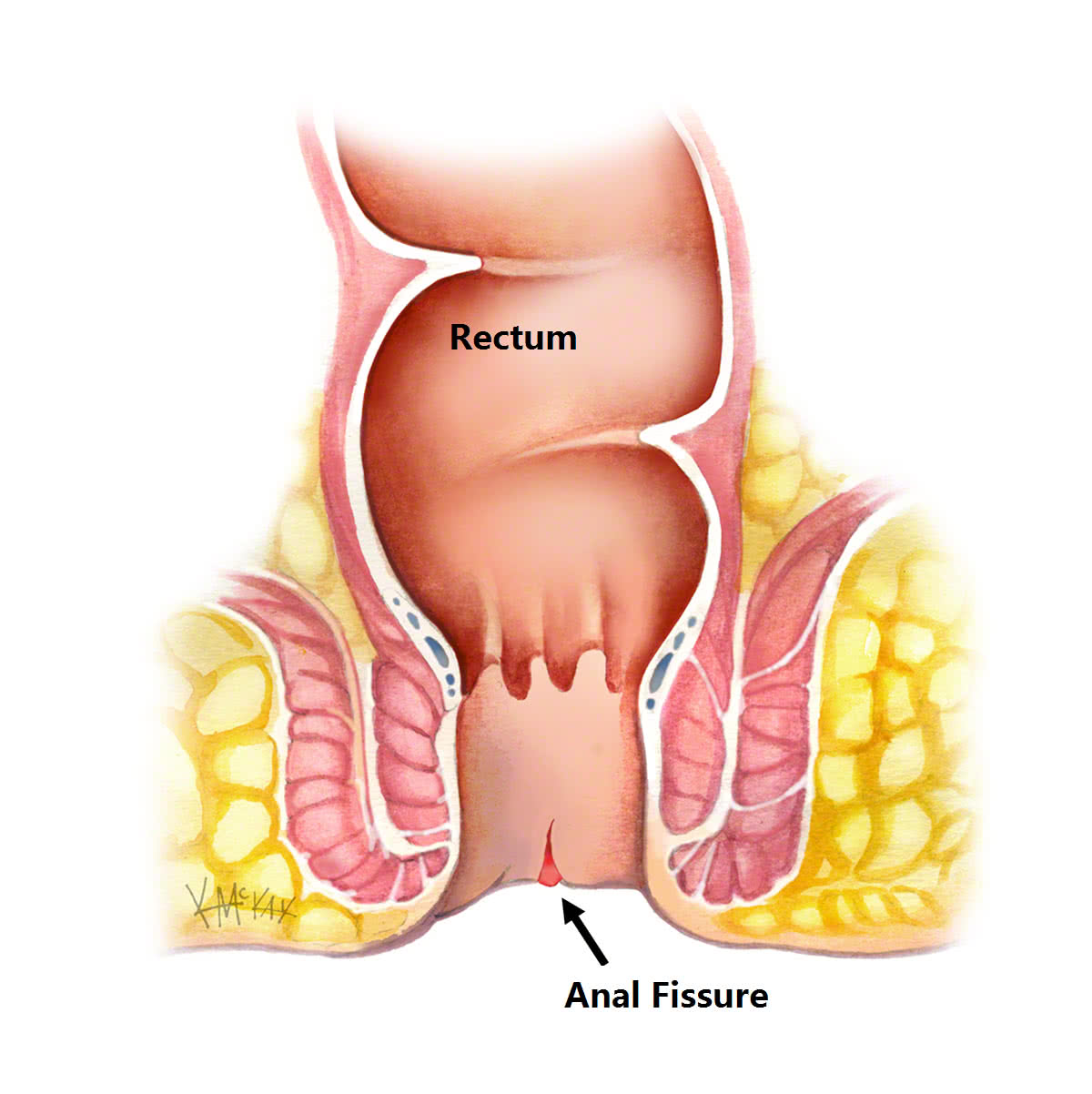 Fissurectomy