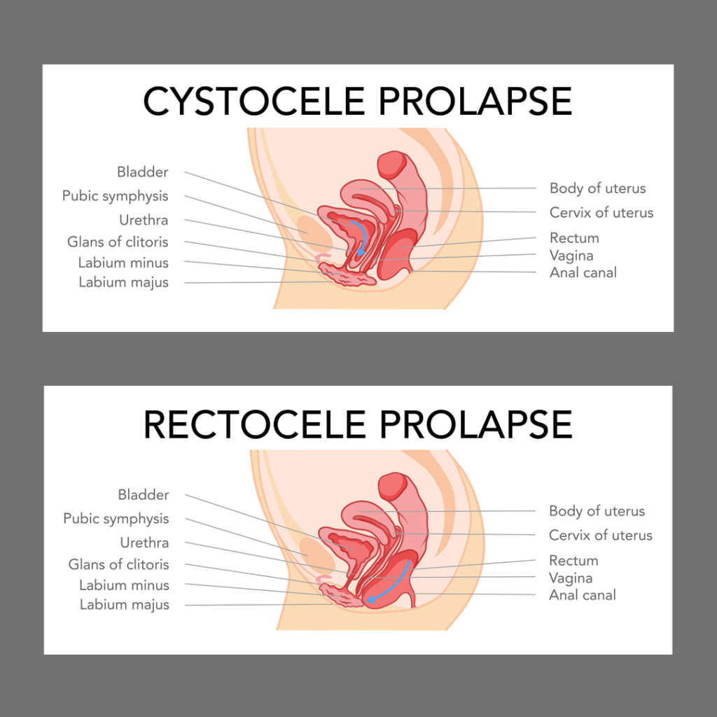 Anterior / Posterior  Colporrhaphy (Cystocele  / Rectocele)