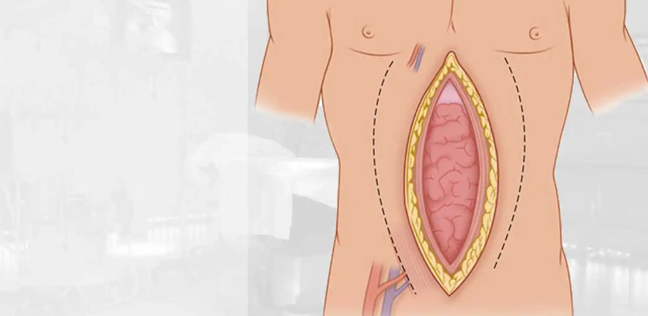 Laparotomy