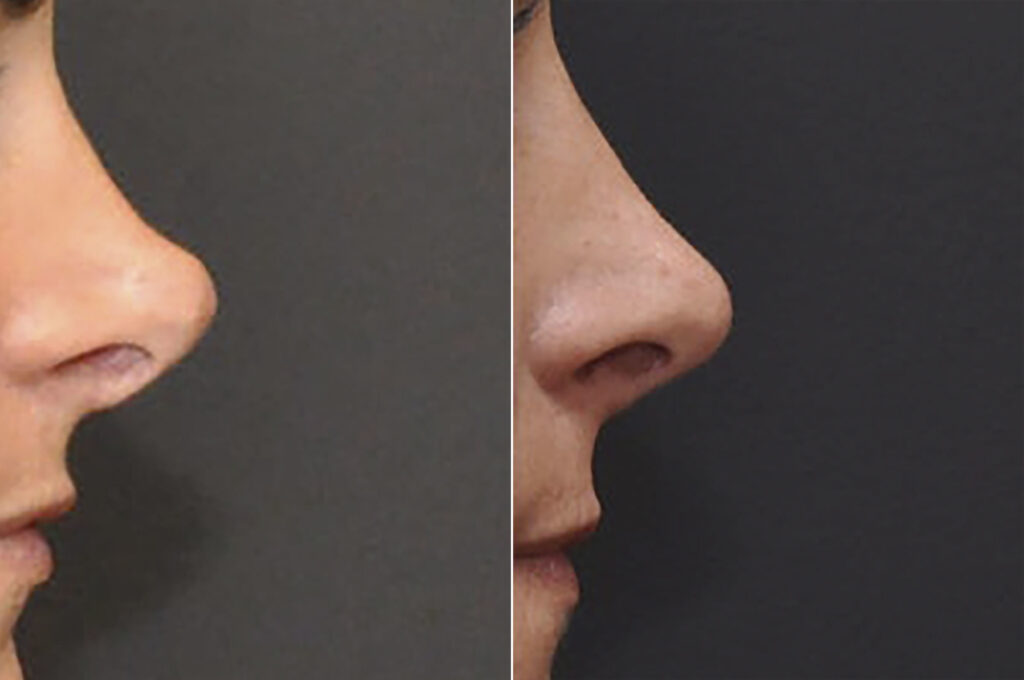 Revision Rhinoplasty