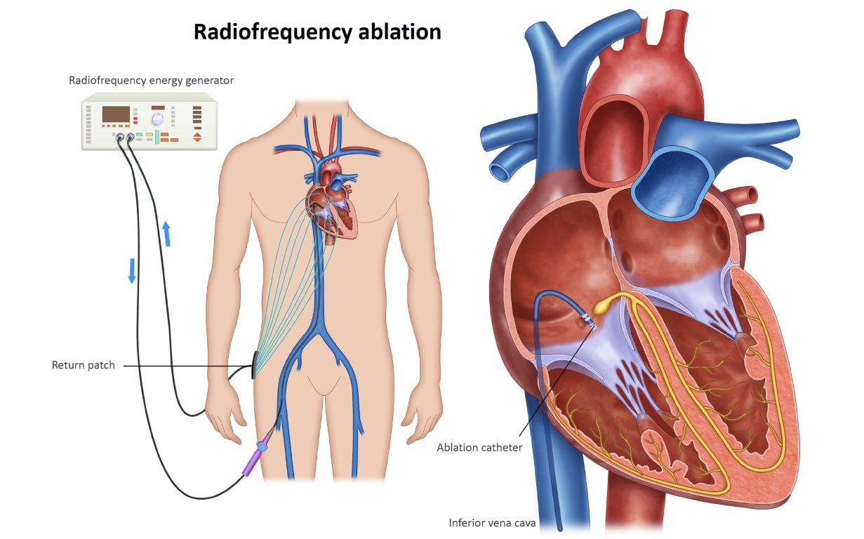 EPS+RFA (Electrophysiology Study with Radiofrequency Ablation)