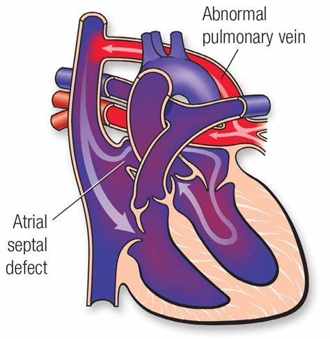 TAPVC (Total Anomalous Pulmonary Venous Connection)