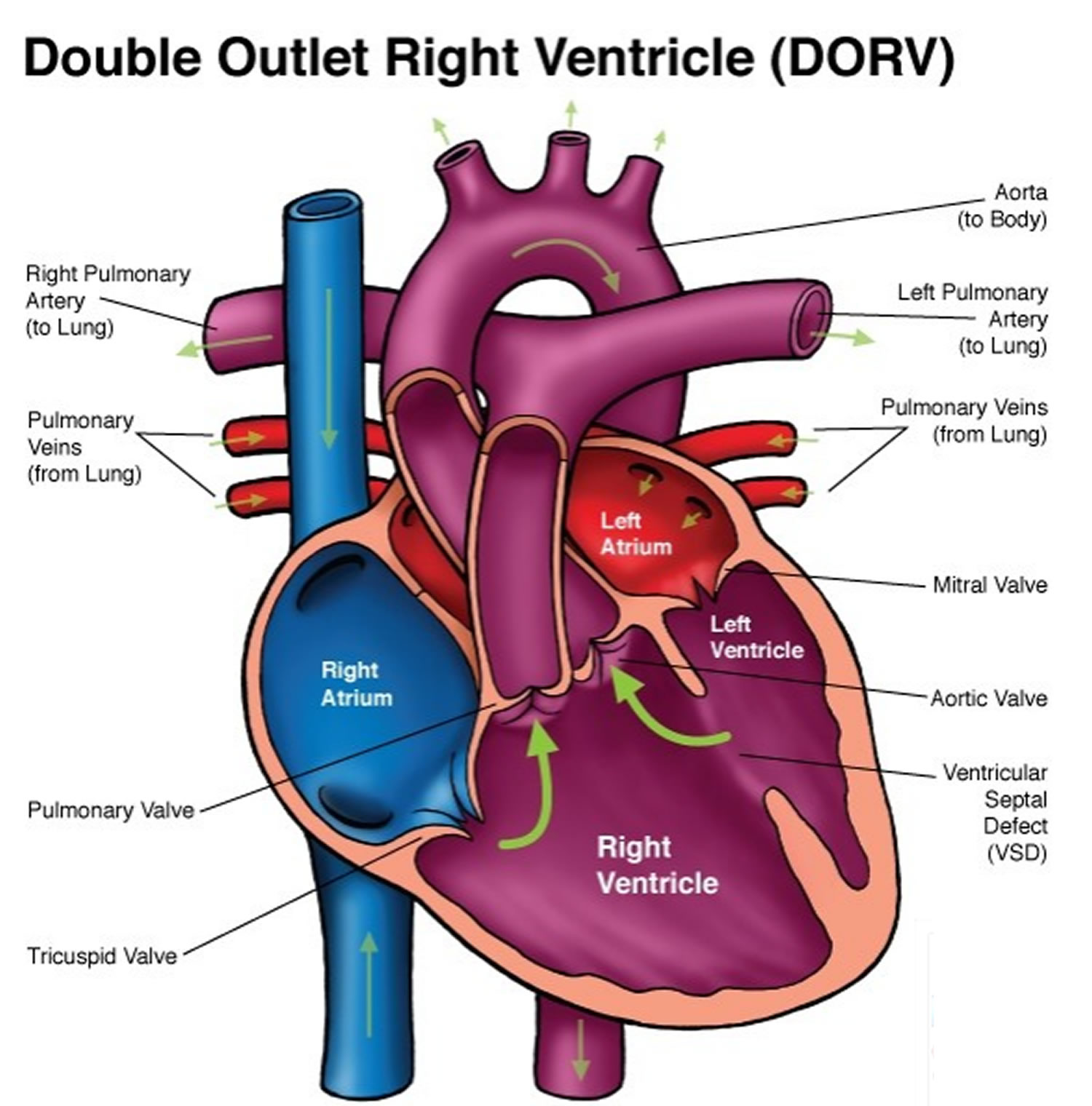 DORV (Double Outlet Right Ventricle)