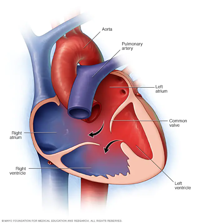 AV (Atrio Ventrcular) Canal